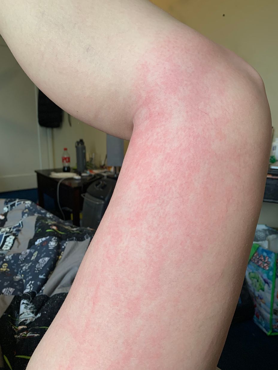<p>Has anyone else experienced this? Today I went for a walk this rash appeared.</p>