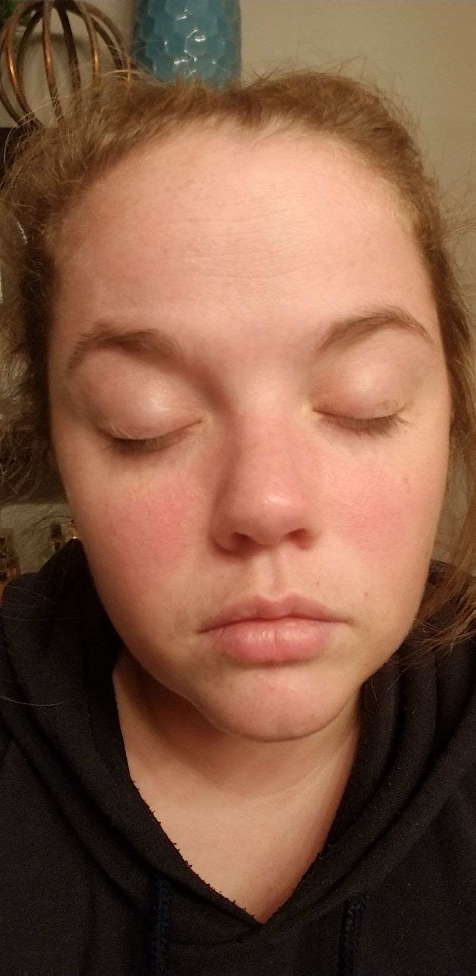 <p>does anyone have a rash like this? I'm undiagnosed and frustrated that it's right on my face...</p>