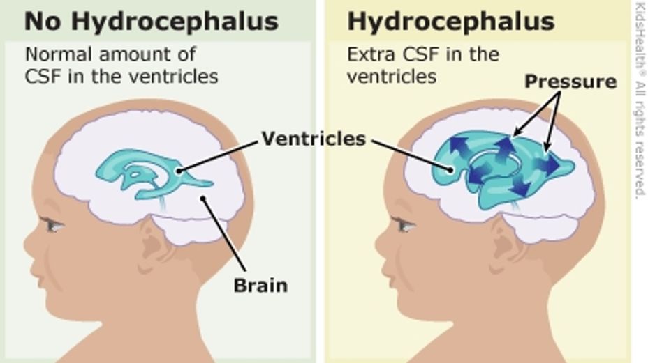 <p>The difference between No <a href="https://themighty.com/topic/hydrocephalus/?label=Hydrocephalus" class="tm-embed-link  tm-autolink health-map" data-id="5b23ce8900553f33fe99473a" data-name="Hydrocephalus" title="Hydrocephalus" target="_blank">Hydrocephalus</a> and <a href="https://themighty.com/topic/hydrocephalus/?label=Hydrocephalus" class="tm-embed-link  tm-autolink health-map" data-id="5b23ce8900553f33fe99473a" data-name="Hydrocephalus" title="Hydrocephalus" target="_blank">Hydrocephalus</a></link></p>