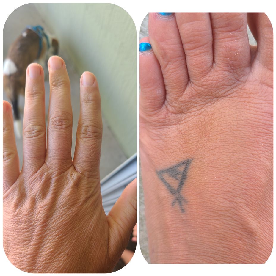 <p>My severe skin changes are concerning. Anyone else have this with <a href="https://themighty.com/topic/undifferentiated-connective-tissue-disease-uctd/?label=UCTD" class="tm-embed-link  tm-autolink health-map" data-id="5b23cec500553f33fe99efc5" data-name="UCTD" title="UCTD" target="_blank">UCTD</a> and autoimmune?</p>