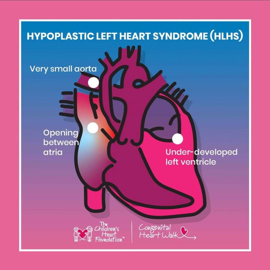 <p><a href="https://themighty.com/topic/hypoplastic-left-heart-syndrome/?label=Hypoplastic Left Heart Syndrome" class="tm-embed-link  tm-autolink health-map" data-id="5b23ce8a00553f33fe9949df" data-name="Hypoplastic Left Heart Syndrome" title="Hypoplastic Left Heart Syndrome" target="_blank">Hypoplastic Left Heart Syndrome</a> (HLHS)</p>